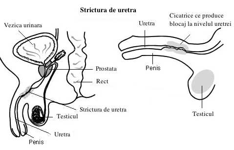 Penis de ce curbura - Măriți lungimea penisului în timpul unei erecții