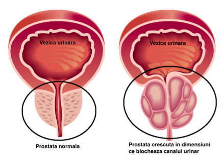 hiperplazia benigna de prostata simptome