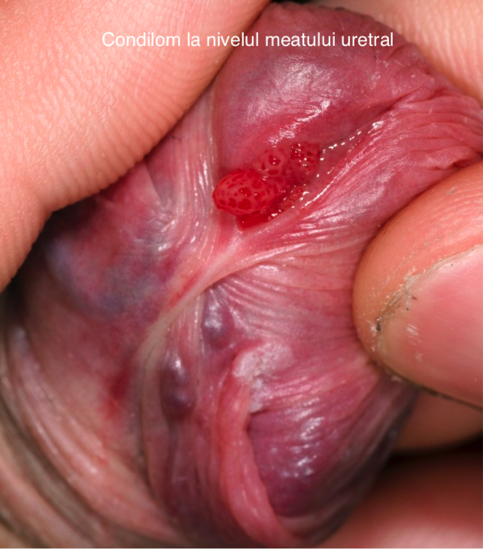 Condilom uretra genitală