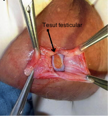 Biopsie testiculara