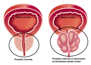 congestie la nivelul glandei prostatei)