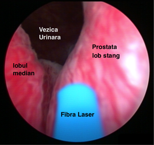 Prostata laser