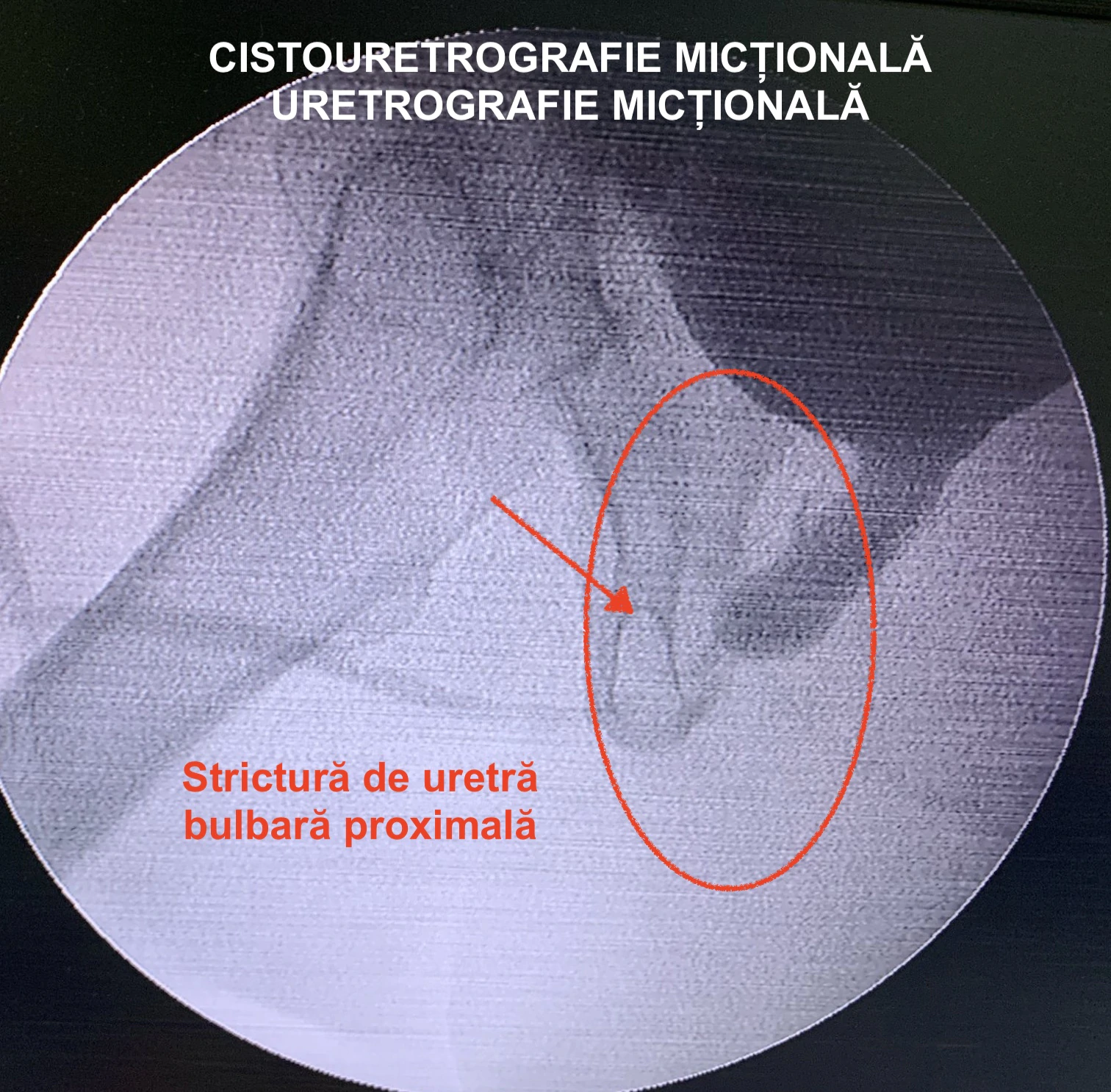 cistouretrografie mictionala