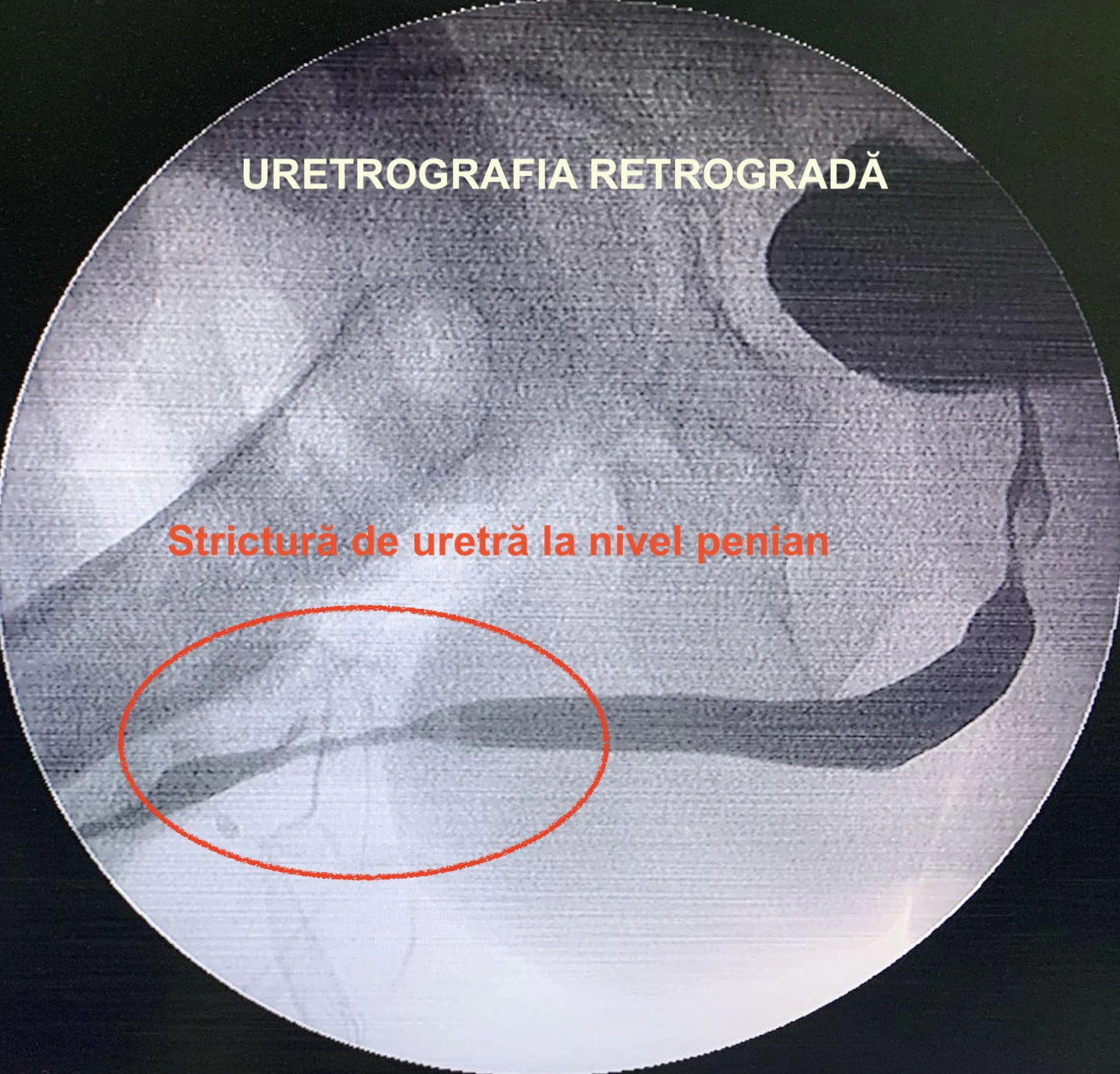 uretrografia retrograda