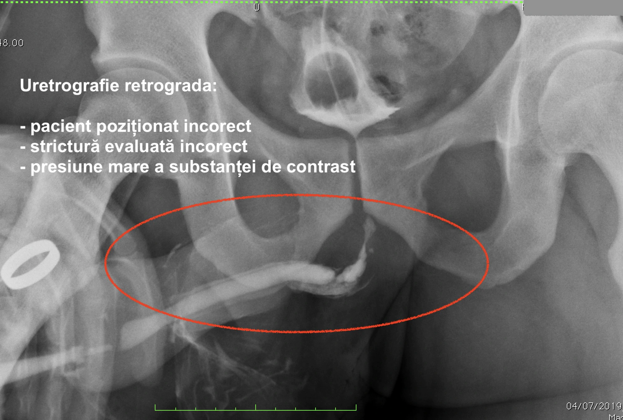 uretrografie pozitie gresita